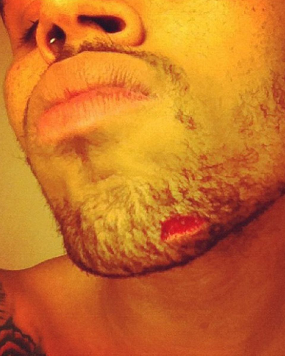 Chris Brown twitterte ein Foto von seiner Kinnverletzung Chris Brown twitterte ein Foto von seiner Kinnverletzung