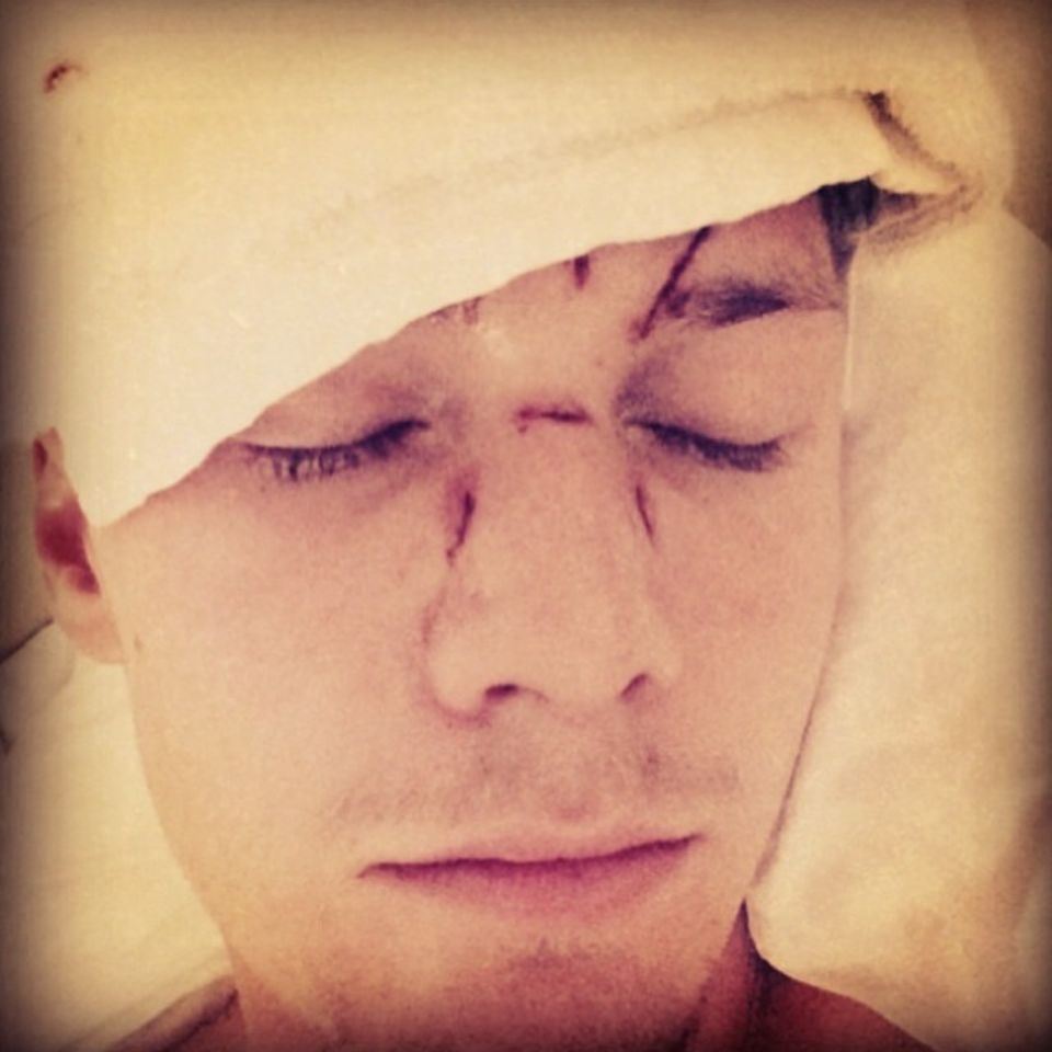 Barron Hilton postete ein Bild mit seinen Verletzungen bei Instagram