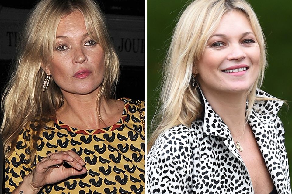 Kate Moss: Zum Vergleich: Als Kate Moss vor zehn Tagen in London unterwegs ist, erkennt man sie an ihren typisch hageren Gesichtszügen. Vor der Fashionshow von Burberry sind diese jedoch viel volleren gewichen. Zum Vergleich: Als Kate Moss vor zehn Tagen in London unterwegs ist, erkennt man sie an ihren typisch hageren Gesichtszügen. Vor der Fashionshow von Burberry sind diese jedoch viel volleren gewichen.