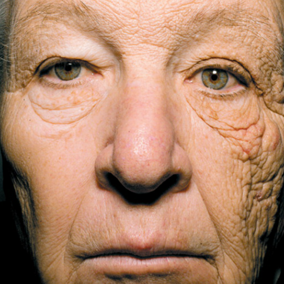 Schockierendes Foto: So rapide altert die Haut ohne Sonnenschutz