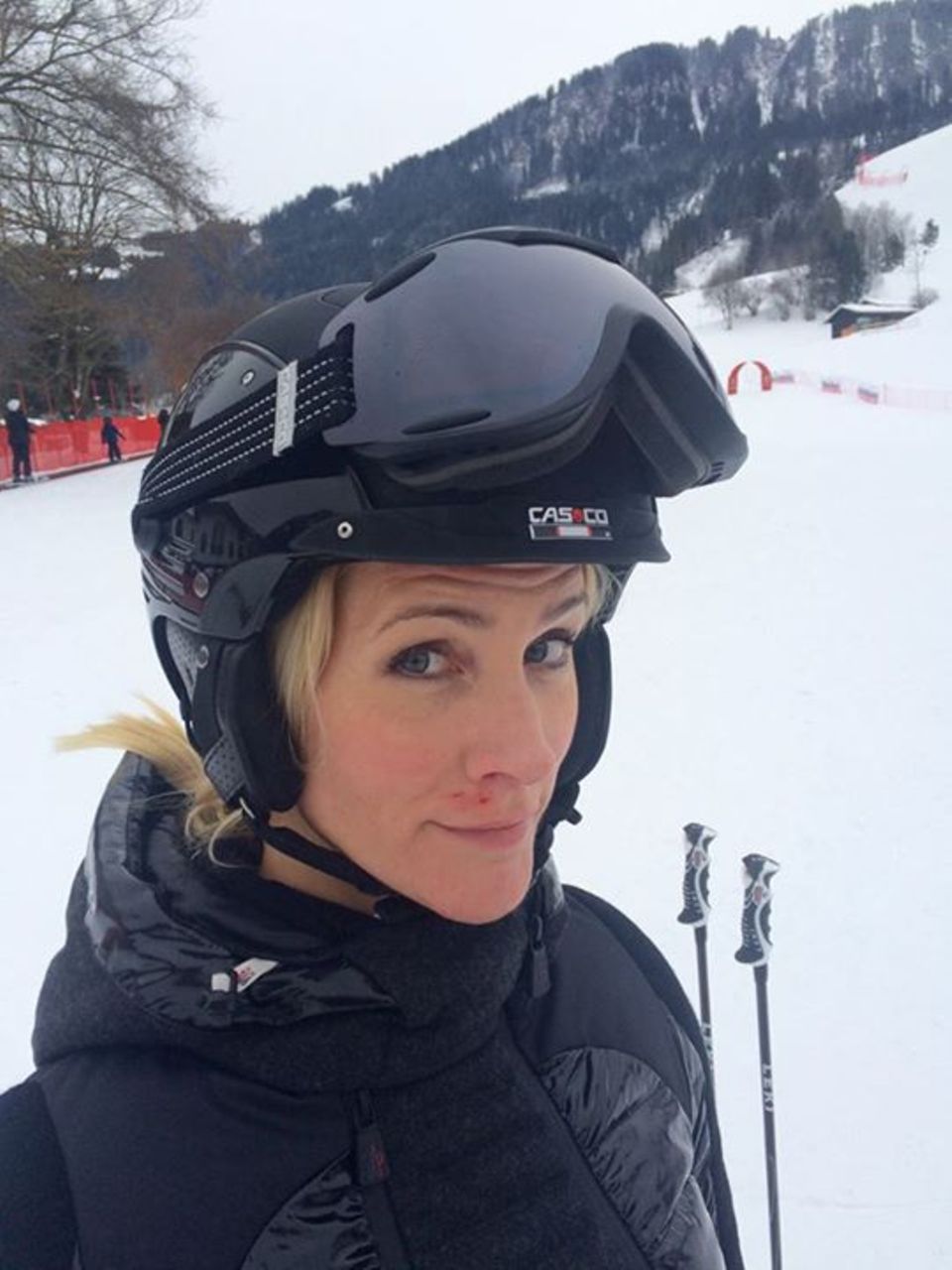 Moderatorin Judith Rakers hatte einen kleinen Skiunfall in Österreich. Auf Facebook teilt sie ein Foto mit ihren Blessuren im Gesicht.