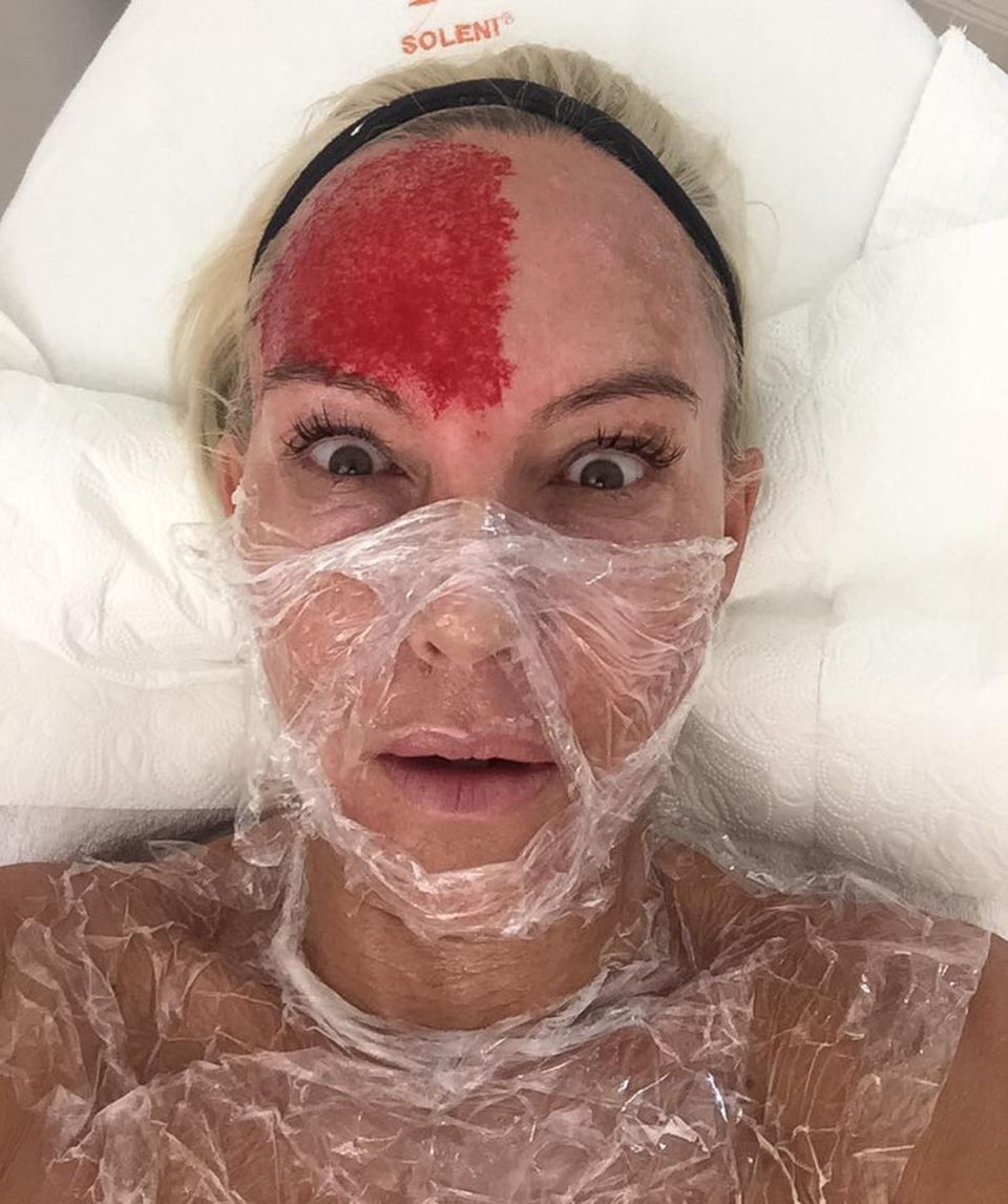 Gruselig! Das "Vampir-Lifting" ist eine Anti-Ageing-Methode, bei der Patienten wie Natascha Ochsenknecht, mit dem eigenen Blutplasma behandelt werden. Das gelangt durch viele kleine Einstiche unter die Haut und hilft ihr, sich wieder aufzubauen. So blutig sieht man natürlich nicht mehr aus, wenn die Behandlung vorbei ist. Gruselig! Das "Vampir-Lifting" ist eine Anti-Ageing-Methode, bei der Patienten wie Natascha Ochsenknecht, mit dem eigenen Blutplasma behandelt werden. Das gelangt durch viele kleine Einstiche unter die Haut und hilft ihr, sich wieder aufzubauen. So blutig sieht man natürlich nicht mehr aus, wenn die Behandlung vorbei ist.
