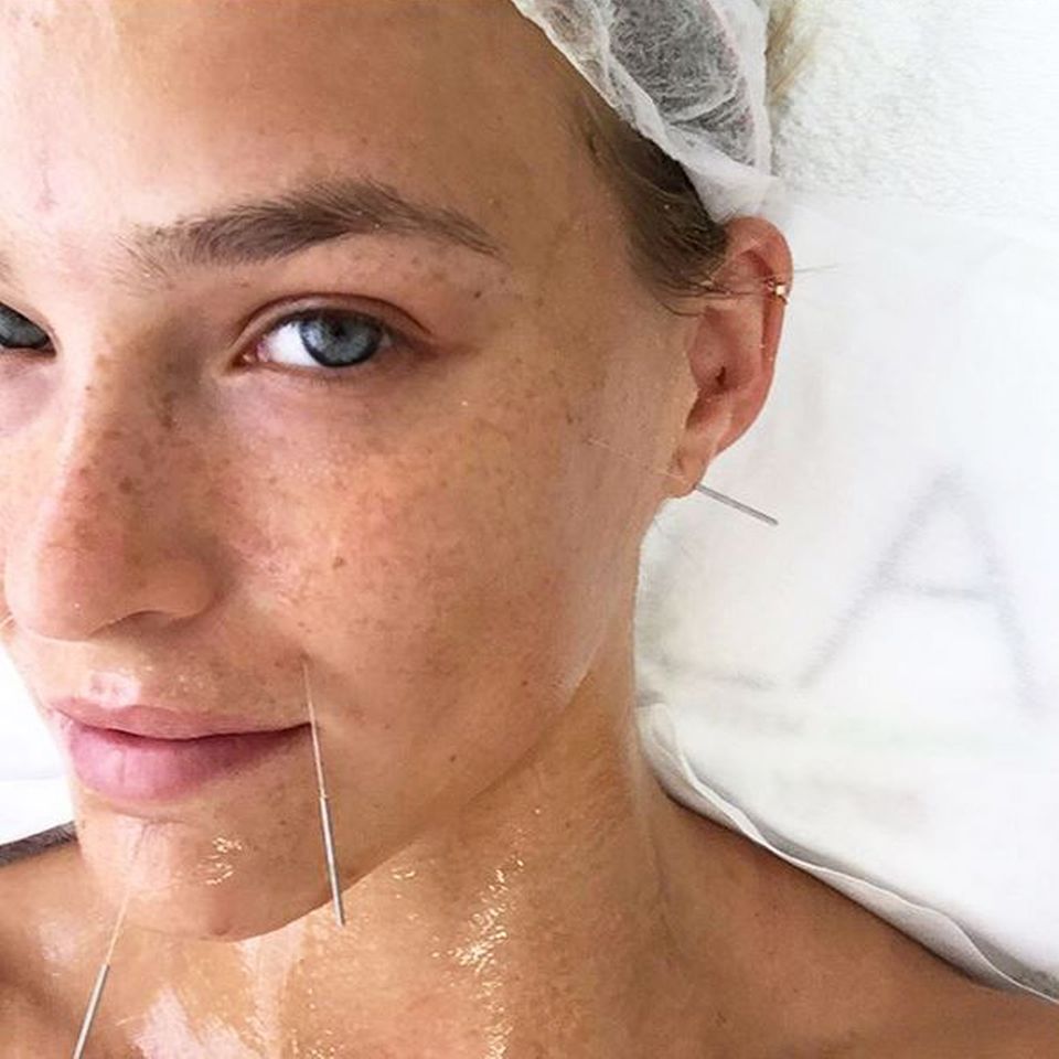 "Weil ich es mir wert bin?" fragt sich Supermodel Bar Refaeli auf Instagram. Eines zeigt dieser Akupunktur-Schnappschuss auf jeden Fall: Wer schön sein will, muss leiden. "Weil ich es mir wert bin?" fragt sich Supermodel Bar Refaeli auf Instagram. Eines zeigt dieser Akupunktur-Schnappschuss auf jeden Fall: Wer schön sein will, muss leiden.