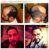 "Backstreet Boy" AJ McLean steht zu seinem Eingriff: Nachdem die beginnende Glatze immer größer wurde, entschied er sich für eine umfassende Haartransplantation. Das Ergebnis präsentiert der Sänger stolz in den sozialen Medien - und erntet viel Lob von seinen Fans.