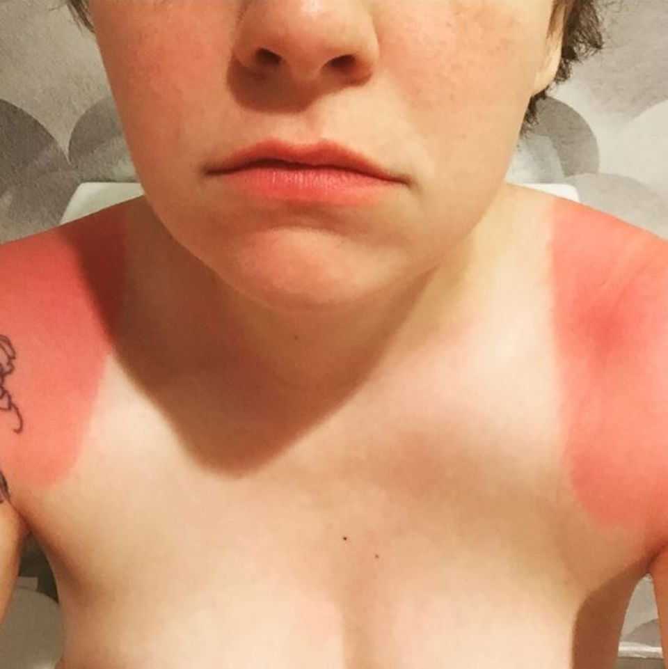 Juli 2015 Lena Dunham ist nicht zu beneiden: "Das passiert wenn ich 10 Minuten in der Sonne bin." kommentiert sie auf instagram. Juli 2015 Lena Dunham ist nicht zu beneiden: "Das passiert wenn ich 10 Minuten in der Sonne bin." kommentiert sie auf instagram.
