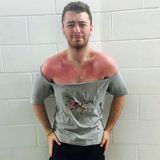 Geteiltes Leid ist halbes Leid: Sam Smith zeigt seinen Fans auf Instagram seinen heftigen Sonnenbrand.