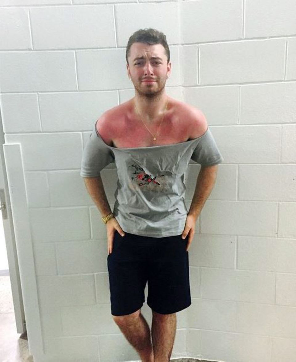 Geteiltes Leid ist halbes Leid: Sam Smith zeigt seinen Fans auf Instagram seinen heftigen Sonnenbrand. Geteiltes Leid ist halbes Leid: Sam Smith zeigt seinen Fans auf Instagram seinen heftigen Sonnenbrand.