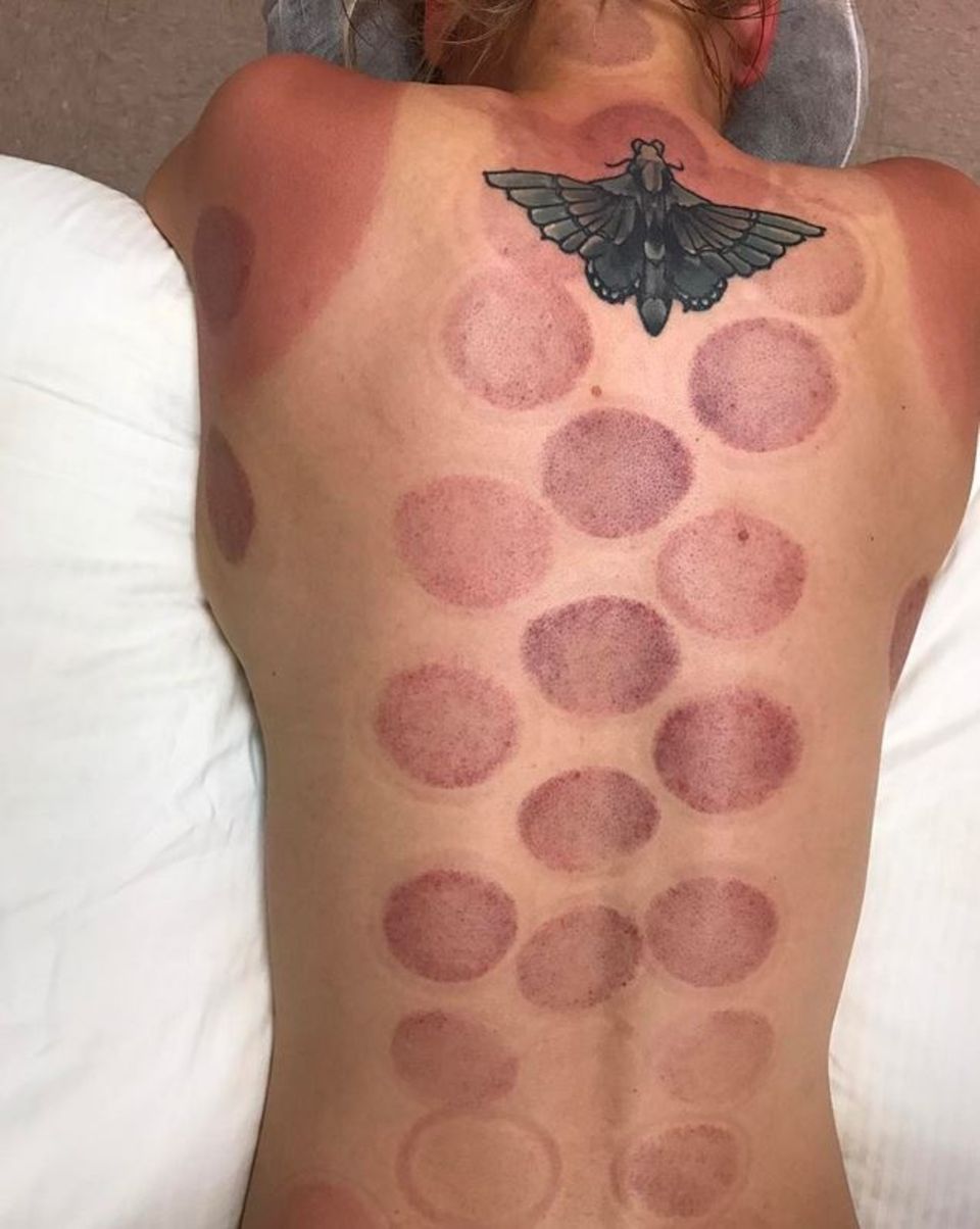 9. März 2017 Wer malträtiert sich hier denn: Ein Sonnenbrand an den Schultern, eine Motte zwischen den Schulterblättern und der ganze Rücken ist gesät mit Schröpf-Abdrucken. Es ist "The Big Bang Theory"-Star Kaley Cuoco. 9. März 2017 Wer malträtiert sich hier denn: Ein Sonnenbrand an den Schultern, eine Motte zwischen den Schulterblättern und der ganze Rücken ist gesät mit Schröpf-Abdrucken. Es ist "The Big Bang Theory"-Star Kaley Cuoco.