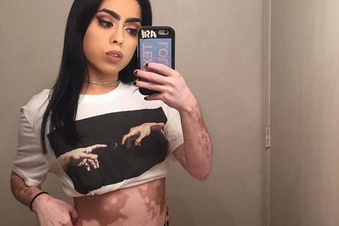 Ashley Soto hat Vitiligo: Körperkunst statt Schönheitsmakel | GALA.de