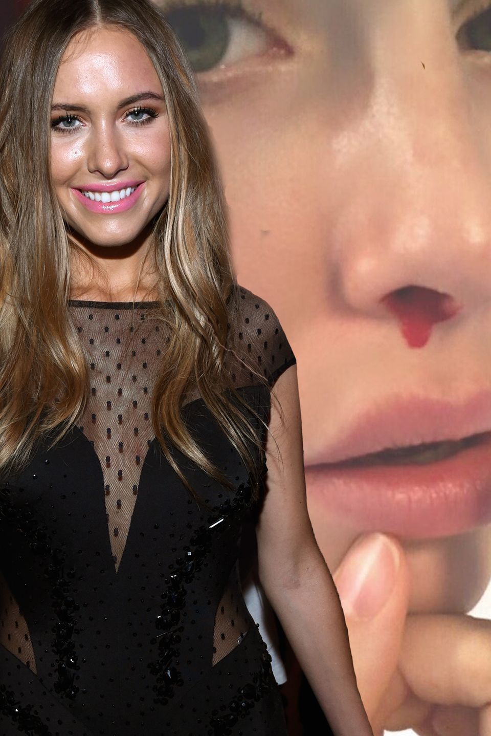 Alena Fritz zeigt ihre blutige Nase auf Instagram