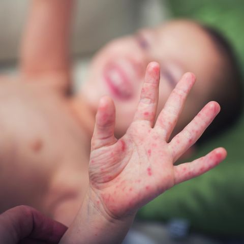 Symptome der Hand-Fuß-Mund-Krankheit