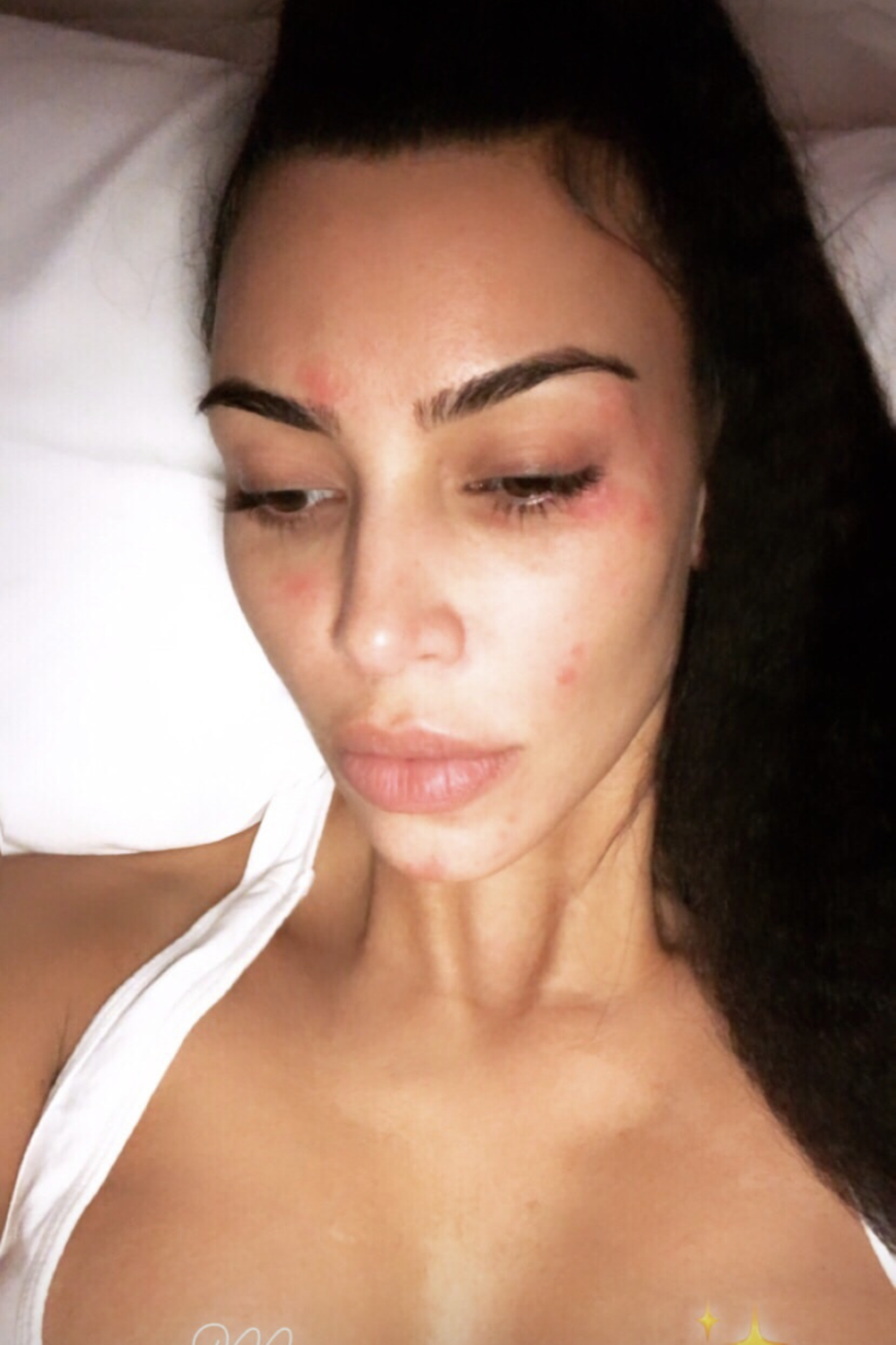 Doch auch Kim bleibt von Hautproblemen nicht verschont. Die roten Flecken in ihrem Gesicht sind Schuppenflechte. Der Reality-Star kämpft seit Jahren gegen die unheilbare Krankheit. "Schuppenflechte am Morgen", schreibt Kim zu diesem Selfie.