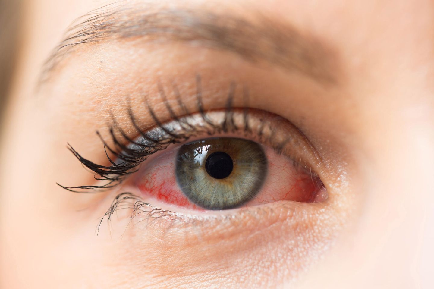 Eine allergische Reaktion kann sich durch gerötete und tränende Augen zeigen