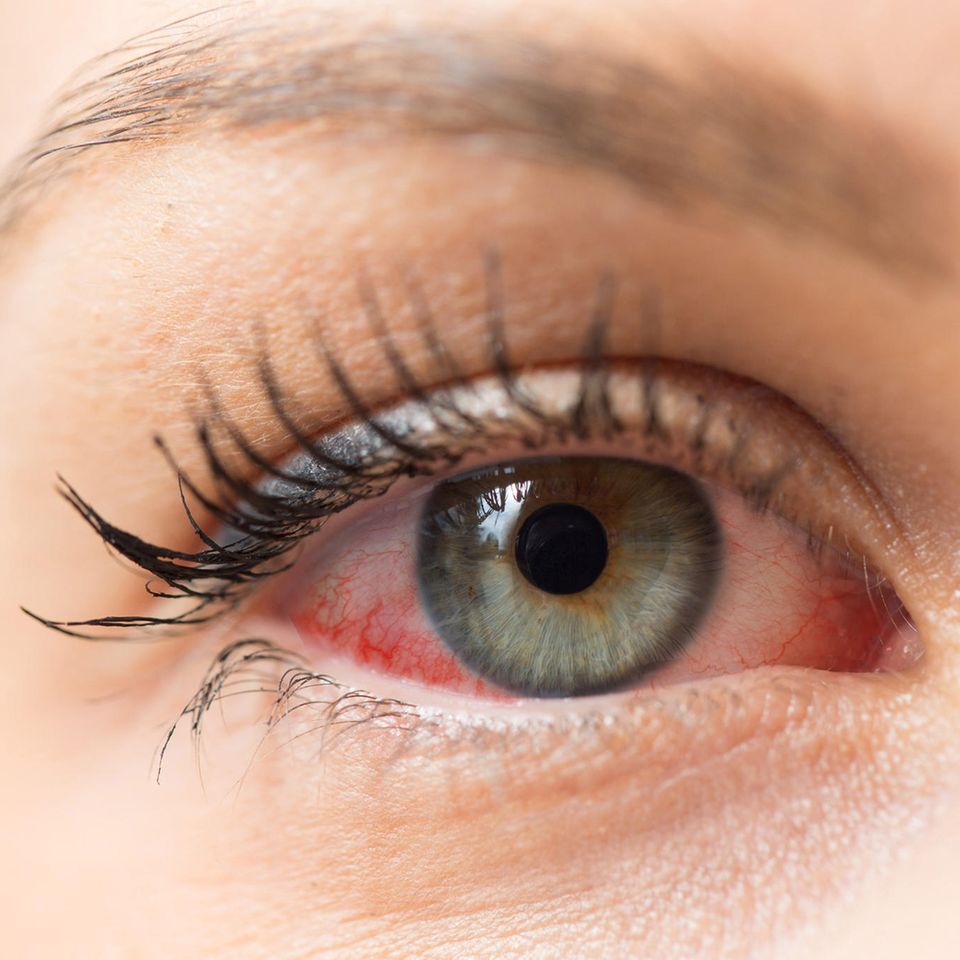 Eine allergische Reaktion kann sich durch gerötete und tränende Augen zeigen