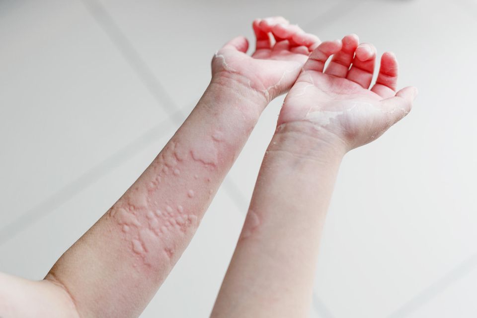 Kälteallergie: Bei einer Kälteallergie bilden sich meist großflächige Quaddeln auf den betroffenen Hautstellen. Bei einer Kälteallergie bilden sich meist großflächige Quaddeln auf den betroffenen Hautstellen.