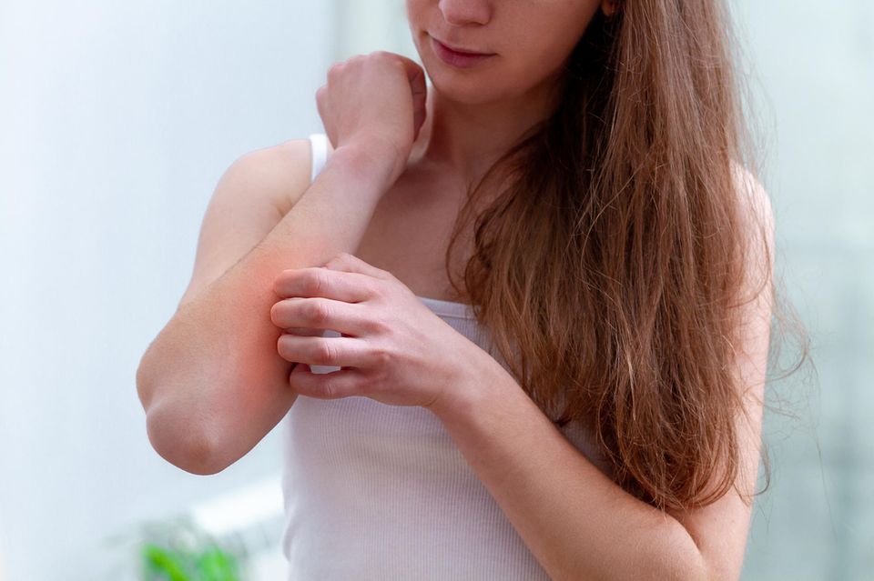 Unangenehm: Wer unter einer Mückenstich-Allergie leidet, hat nach einem Angriff der Beißer mit starkem Juckreiz und großflächigen Schwellungen zu kämpfen.
