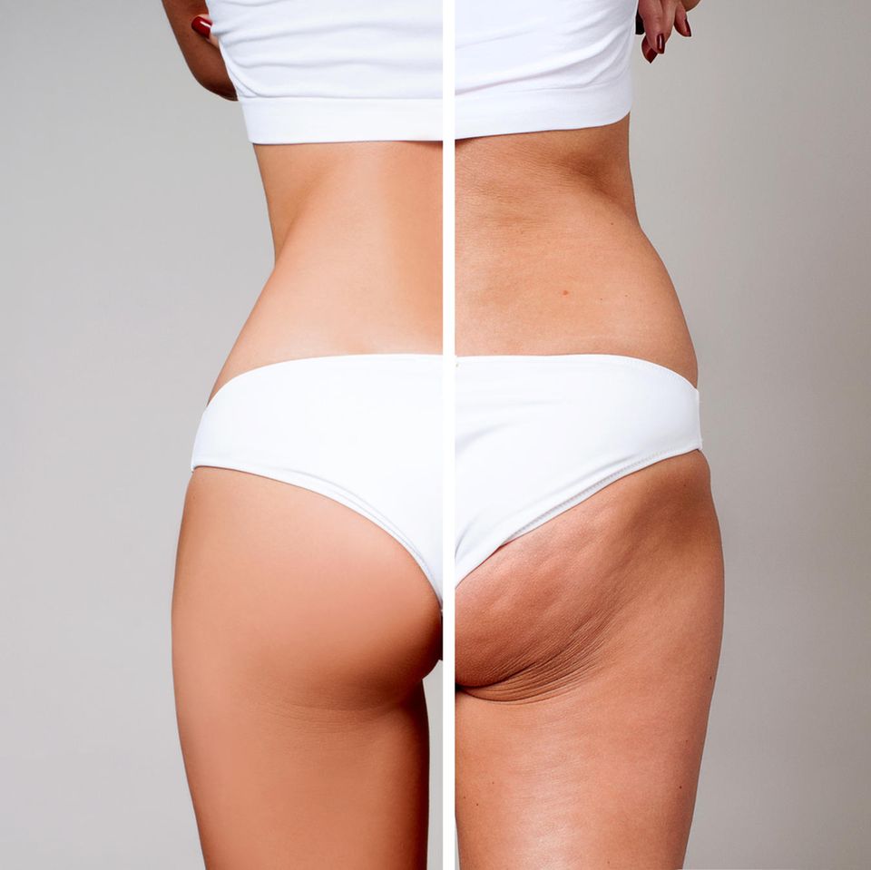 Cellulite – bis zu 90 Prozent der Frauen betrifft es