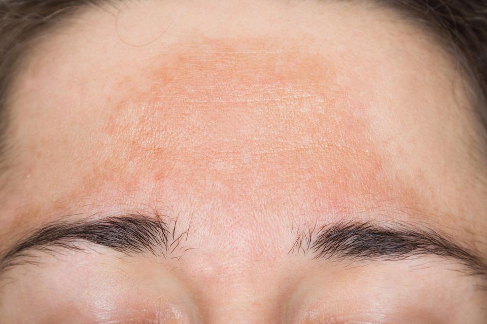 Die Pigmentflecken beim Melasma treten typischerweise an der Stirn auf