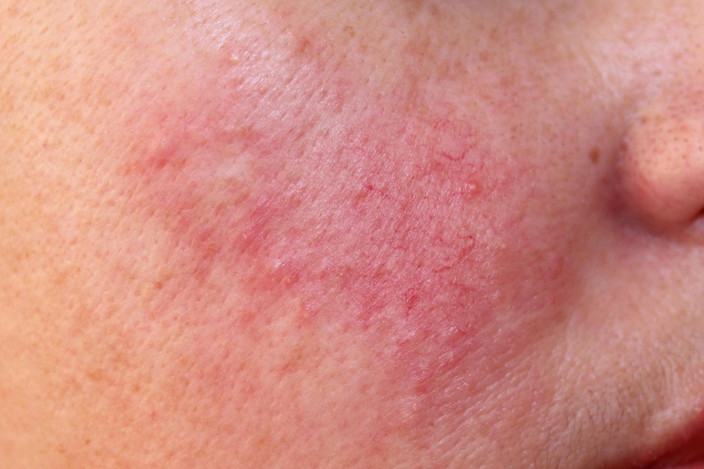 Rosacea: Ursachen und Behandlungsmethoden | GALA.de