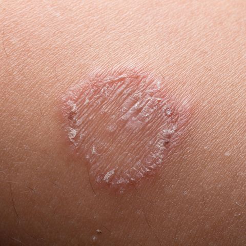 Hautpilz sollte immer von einem Dermatologen behandelt werden.