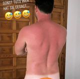 Daniel Völz urlaubt aktuell mit seiner neuen Herzdame in Spanien und scheint bei all den Schmetterlingen im Bauch glatt vergessen zu haben, Sonnencreme zu benutzen. "'Eincremen', hat sie gesagt. 'Sonst tut's weh', hat sie gesagt", witzelt der Ex-Bachelor auf Instagram und zeigt seinen Followern seinen verbrannten Rücken. 