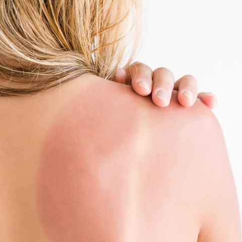 Sonnenbrand: Frau mit Sonnenbrand auf der Schulter