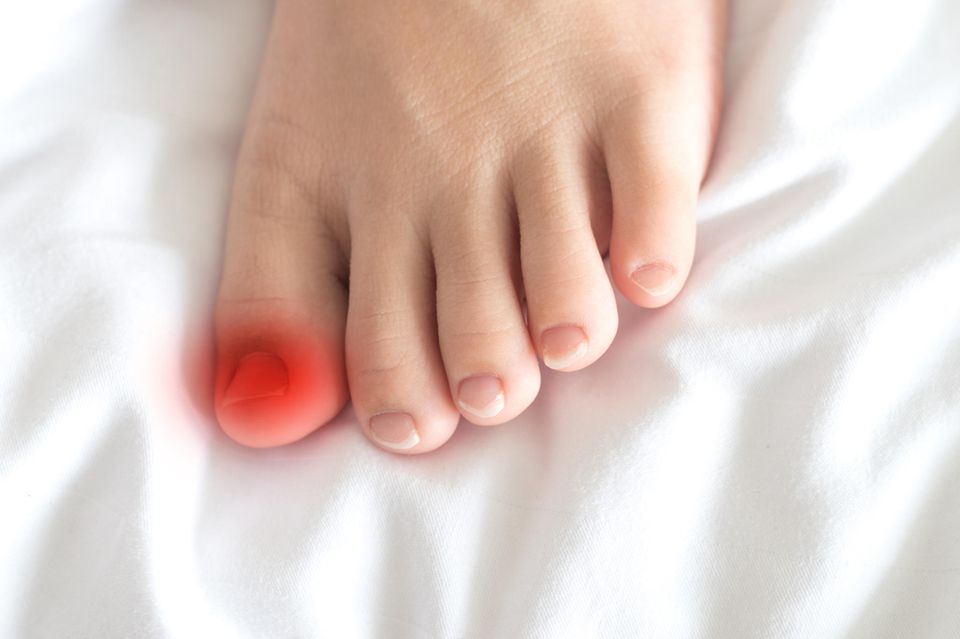 Ein Eingewachsener Zehennagel ist in den meisten Fällen sehr schmerzhaft. 