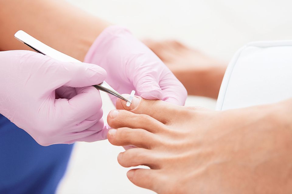 In der professionellen Fußpflege, verpasst der Podologe dem eingewachsenen Zehennagel eine Nagelspange. 