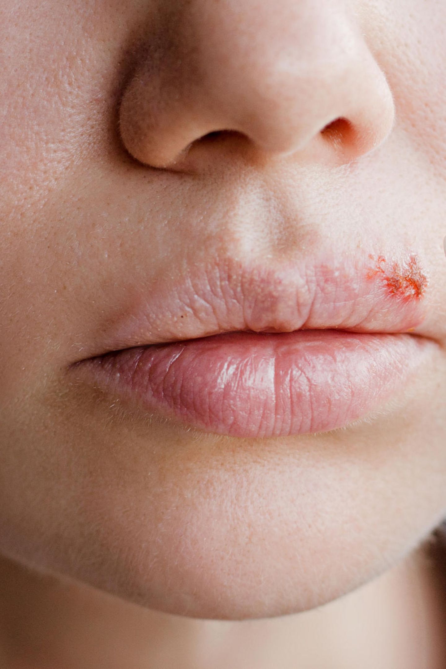 Herpes küssen trotz Herpes: Das