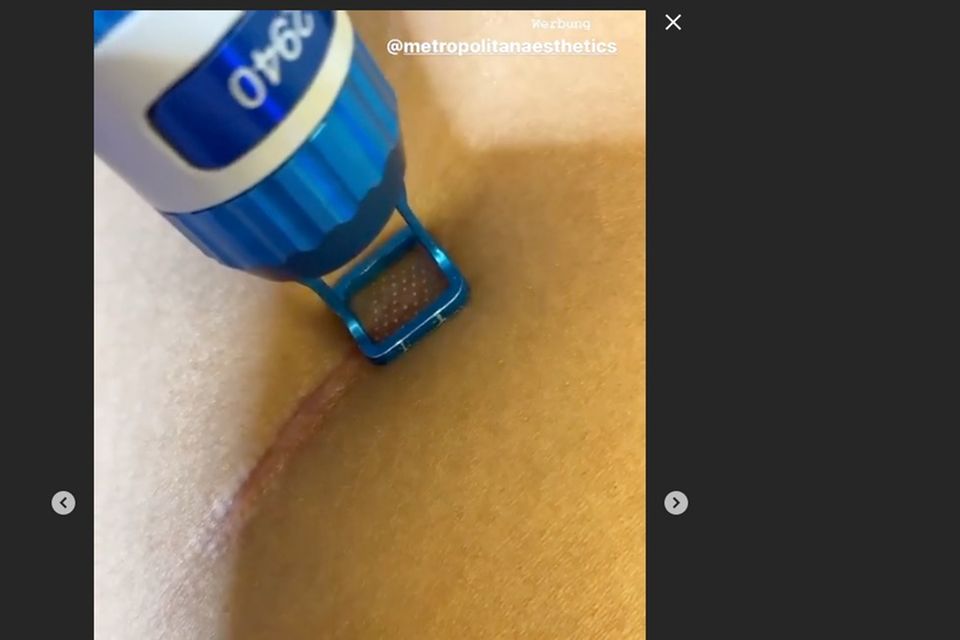 Sarah Lombardi: Sarah Lombardi lässt eine Narbe mit Laser behandeln. Sarah Lombardi lässt eine Narbe mit Laser behandeln.