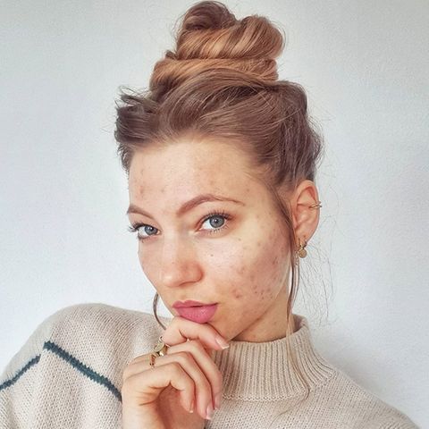 Unreine Haut im Gesicht: Hanna Bohnekamp zeigt ihre Akne.