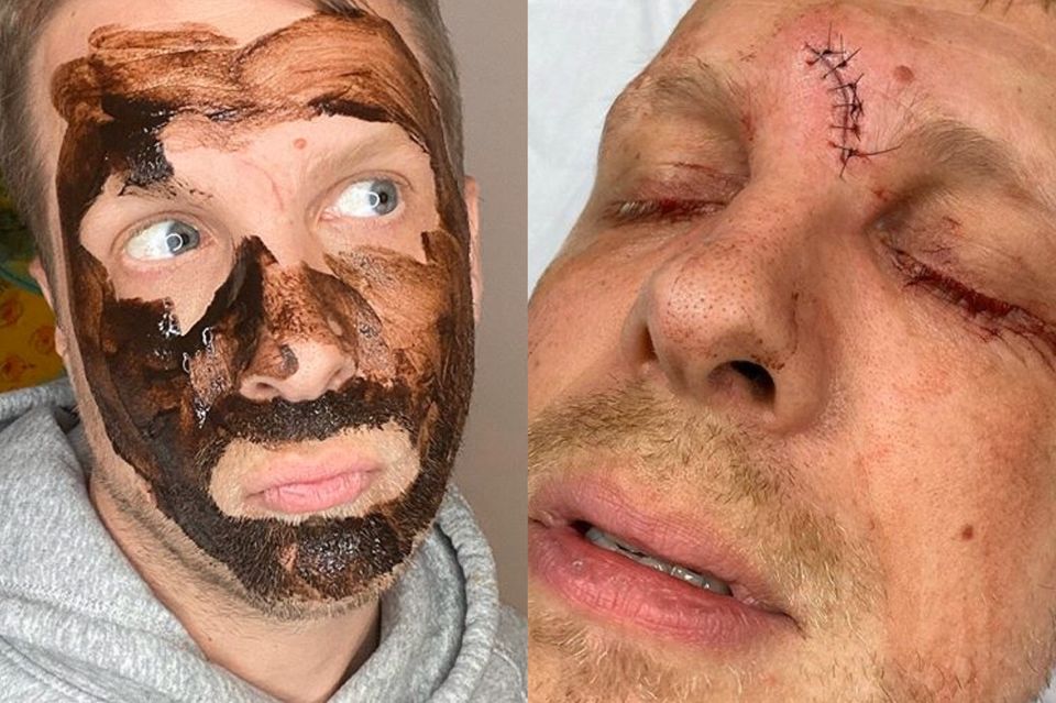 Oliver Pocher : Botox lässt seine Stirnnarbe fast verschwinden