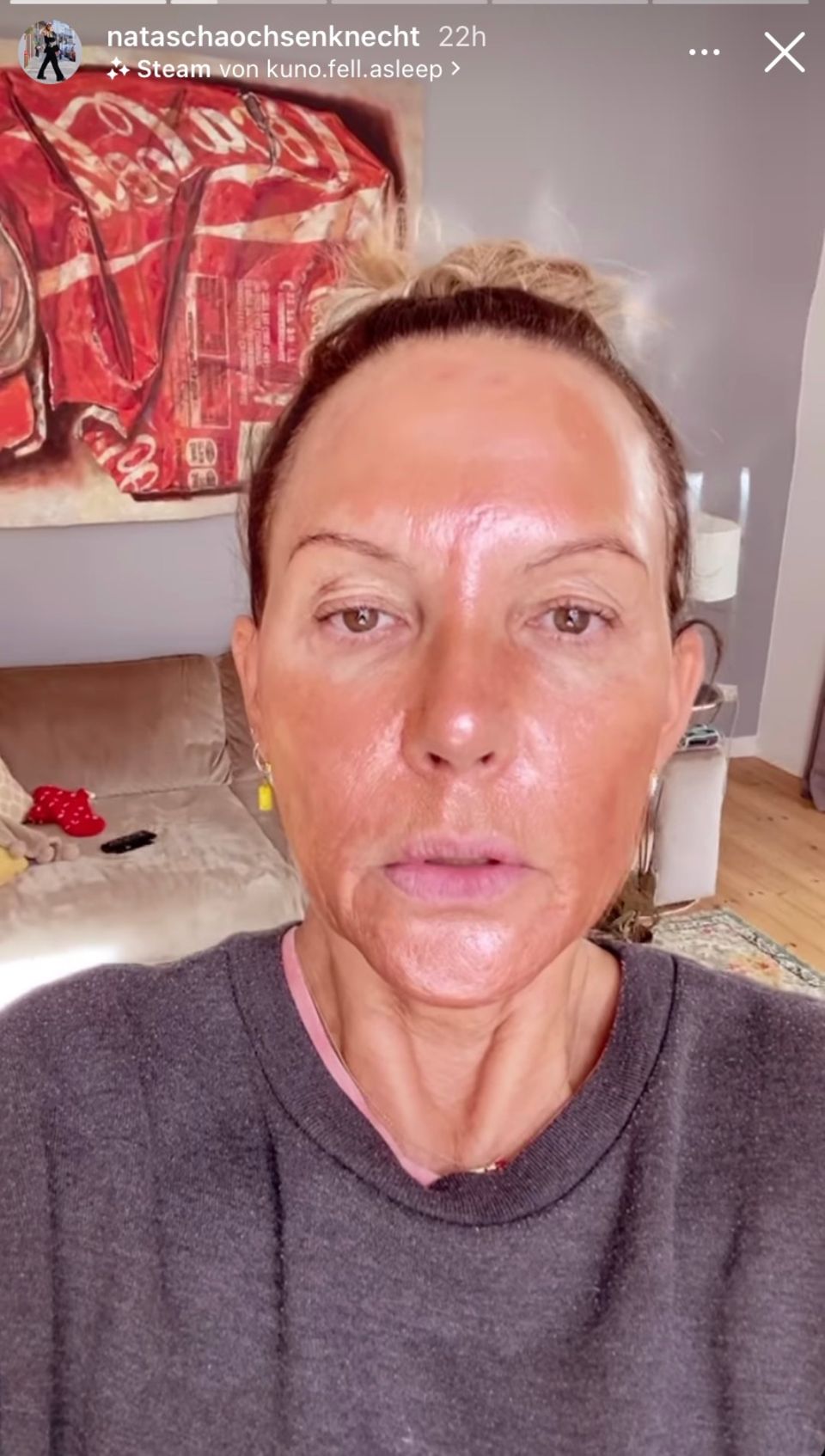 Natascha Ochsenknecht: Gerötetes Gesicht und überstraffe Haut: Natascha Ochsenknecht erkennt sich selbst kaum wieder. Gerötetes Gesicht und überstraffe Haut: Natascha Ochsenknecht erkennt sich selbst kaum wieder.