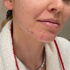 Selbstbewusst zeigt Chiara Ferragni daher auch ihren letzten Akne-Ausbruch am Kinn. Ihr Motto: Auch an Tagen, an denen die Haut einfach nicht mitspielen will, darf das Gesicht mit Stolz in die Kamera gehalten werden. 