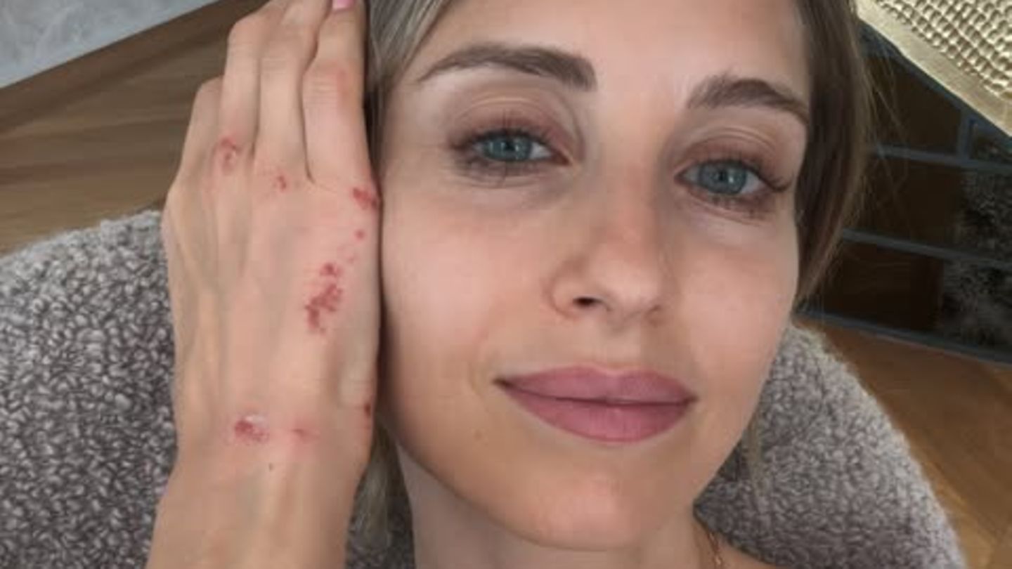 Cathy Hummels Unfall erschüttert Fans - sie zeigt ihre blutigen Wunden