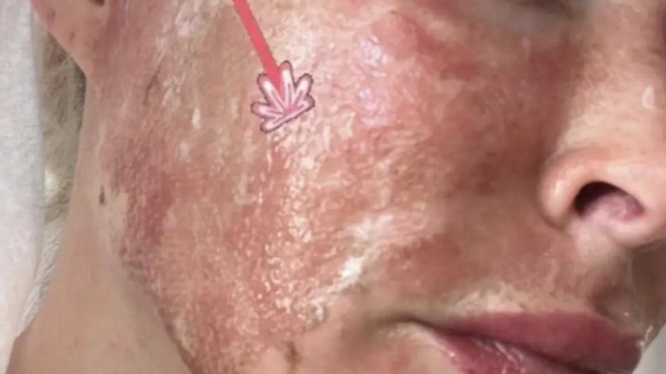 Das sieht schmerzhaft aus: Daniela Katzenberger zeigt ihre verbrannte Haut nach einem Lasertreatment auf Instagram. 